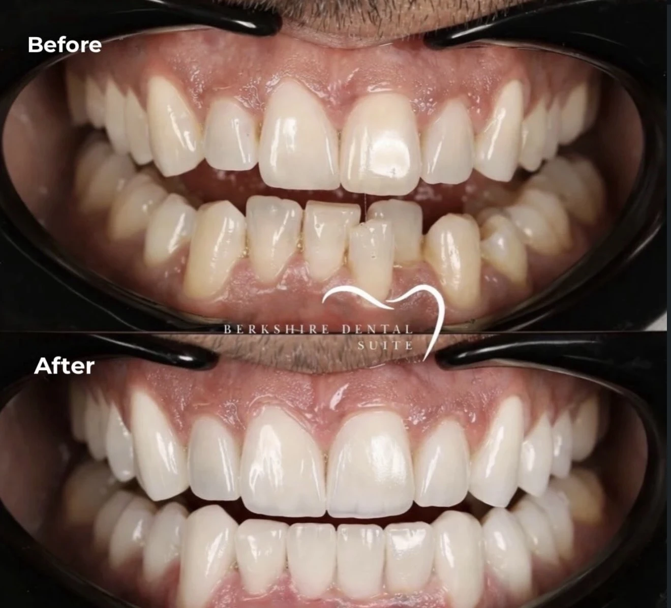 Complete original BDS smile-gallery clinical before and after pair; treatment unspecified