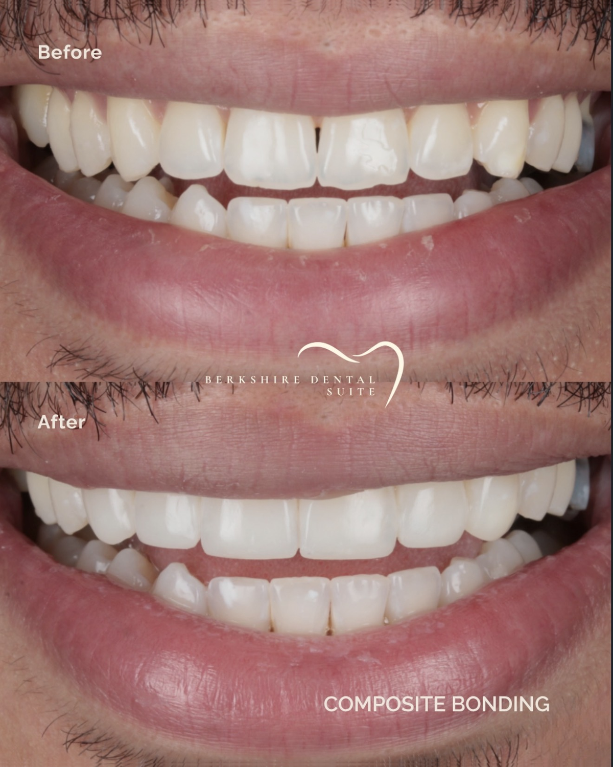 Whole original BDS before and after composite bonding example